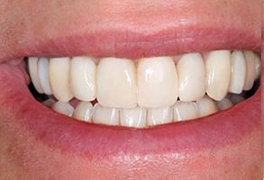 Smile Dental Office, PC | Ceramic Crowns, Veneers and Dental Bridges